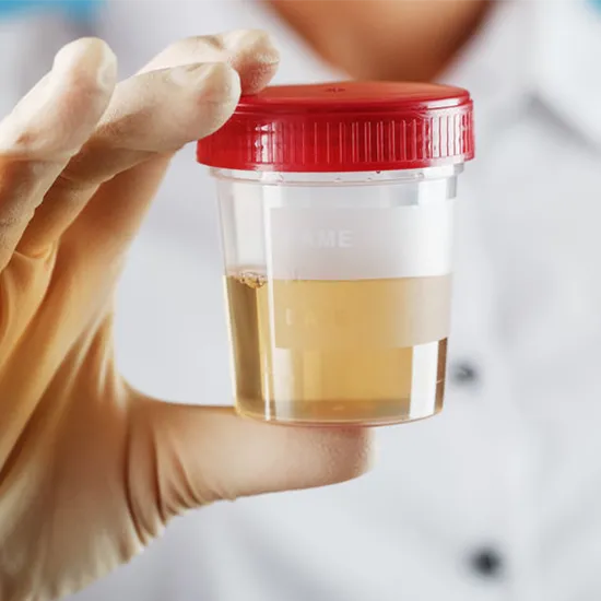 urine glucose test